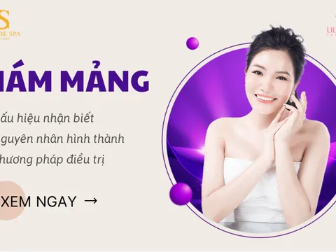 Nám Mảng: dấu hiệu nhận biết, nguyên nhân, phương pháp điều trị nám hiệu quả