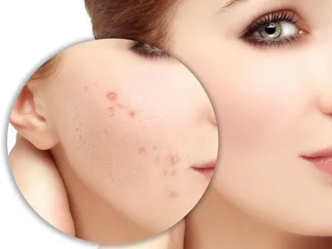 5 cách trị thâm mụn đơn giản và hiệu quả ngay tại nhà