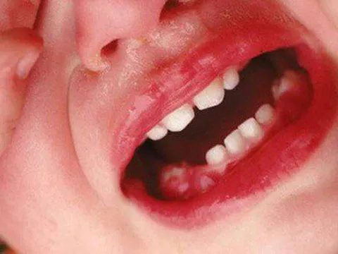 Bài thuốc chữa viêm lợi, hôi miệng