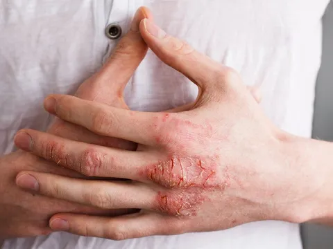 Nhận biết và kiểm soát viêm da tiếp xúc