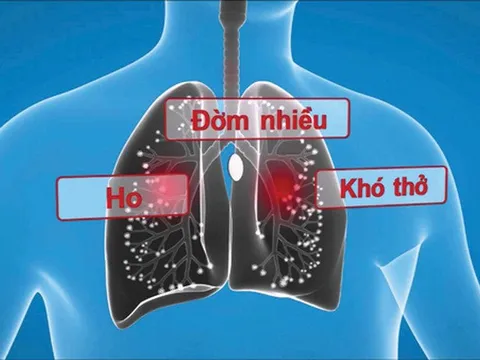 Một số phương thuốc hay chữa đàm nhiệt khái thấu