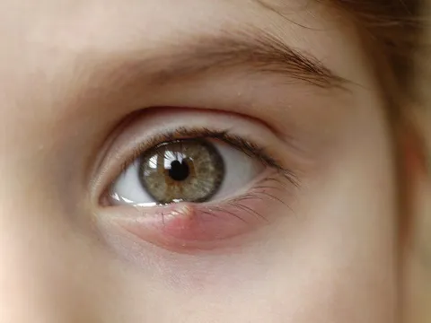 Nên làm gì khi bị lẹo?