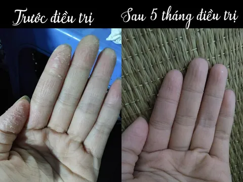 XÓA TAN NỖI LO Á SỪNG BẰNG BÀI THUỐC THẢO DƯỢC
