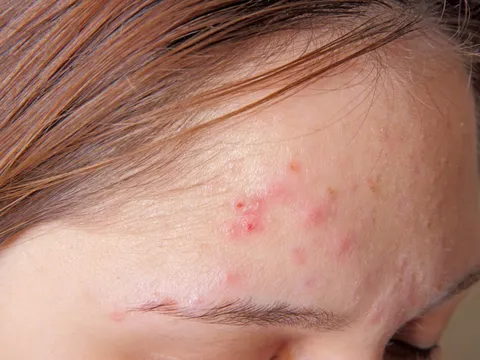 MỤN TRỨNG CÁ – NỖI ÁM ẢNH VÌ LÀN DA XẤU XÍ