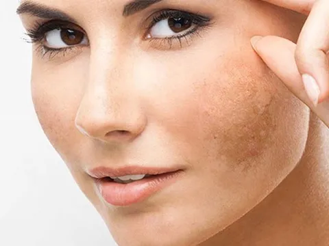 Giải mã bí mật của viên uống mờ nám đang được chị em…