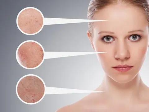 Giải mã những điều chị em chưa biết về nám, sạm da