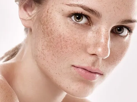 Phân biệt nám nội tiết tố và nám môi trường. Đâu là giải pháp trị nám hiệu quả