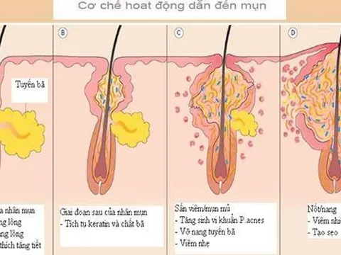 AZACNÉ – “VŨ KHÍ” MỚI GIÚP XÓA SỔ MỤN TRỨNG CÁ VIÊM