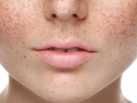 TẠI SAO BABOLICA LÀ PHƯƠNG PHÁP CẢI THIỆN NÁM, TÀN NHANG HIỆU QUẢ?