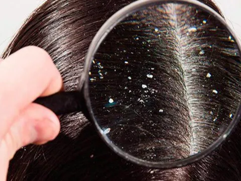 5 cách trị gàu mảng dứt điểm tại nhà