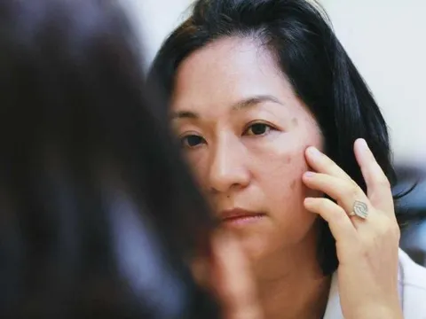 Những sai lầm khiến việc trị nám không đạt kết quả